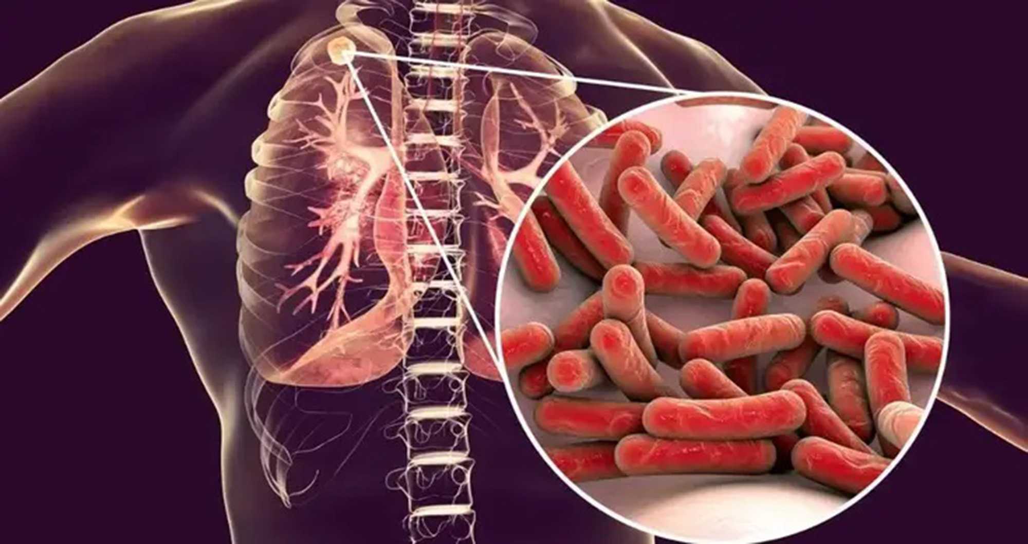 Туберкульоз виліковний, якщо…