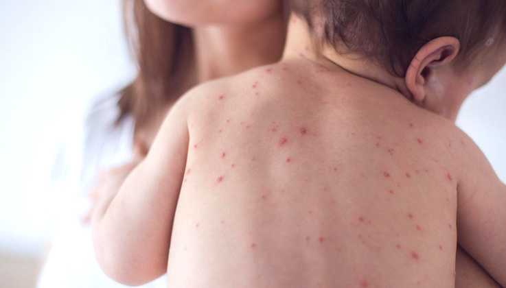 Низький рівень вакцинації проти кору спричинив стрімке поширення хвороби