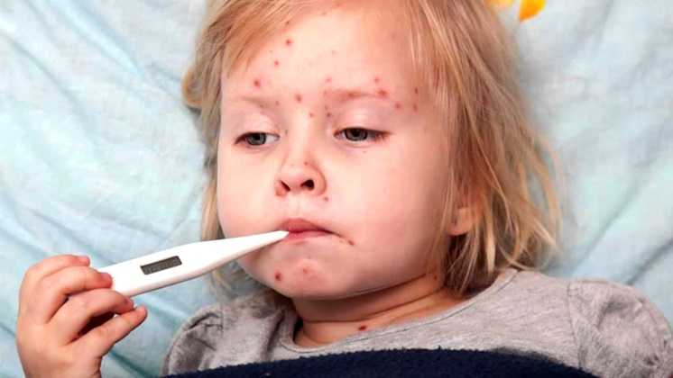 Вітряна віспа – ще одна лідерка серед осінніх хвороб