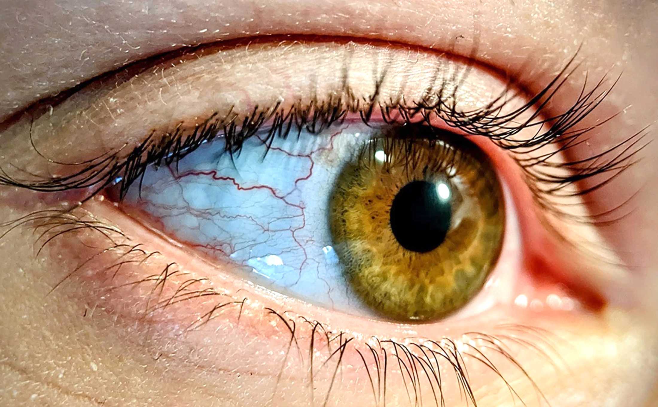 Глаукома приходить тихо...