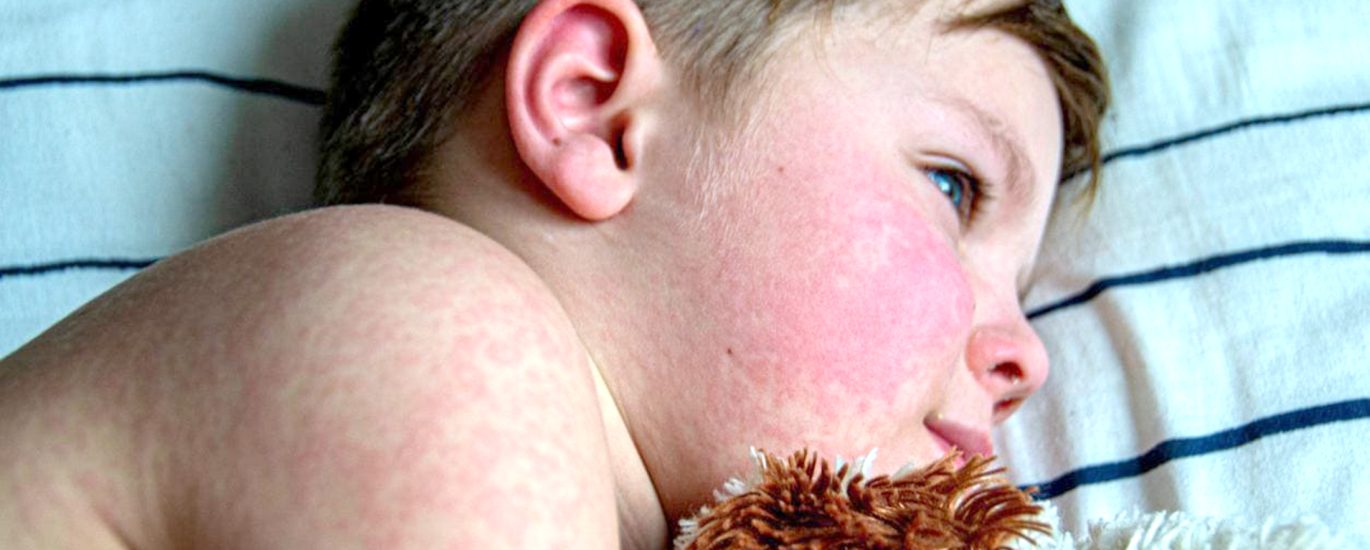 Кір: запобігти здатна лишень вакцинація