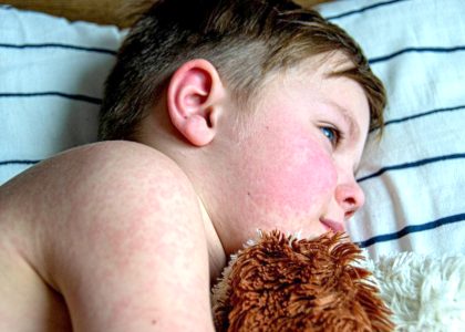 Кір: запобігти здатна лишень вакцинація