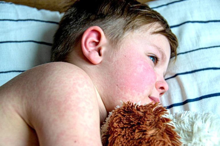 Кір: запобігти здатна лишень вакцинація